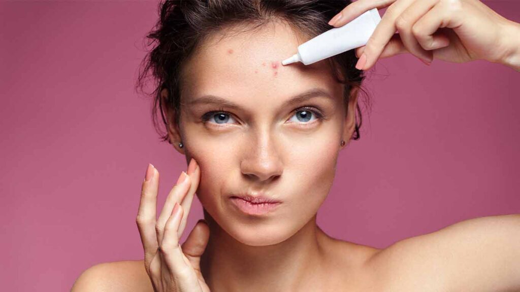 Image of young woman applying lotion to acne on face